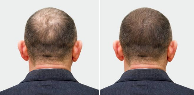 Before &After